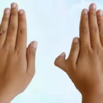 हाथ में छठी उंगली (पॉलीडैक्टिली) का क्लोज़अप, सामुद्रिक शास्त्र के अनुसार विश्लेषण